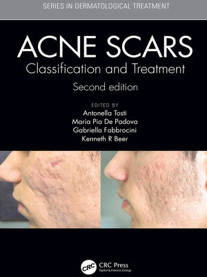 cover image of Acne Scars